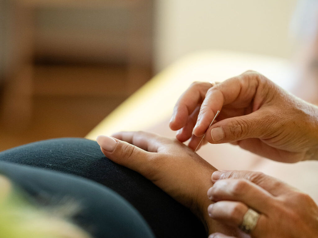 Akupunktur. Akupunkturnadel wird von Melanie Feller, Therapeutin in Traditioneller Chinesischer Medizin (TCM) an der Hand einer Patientin gesetzt